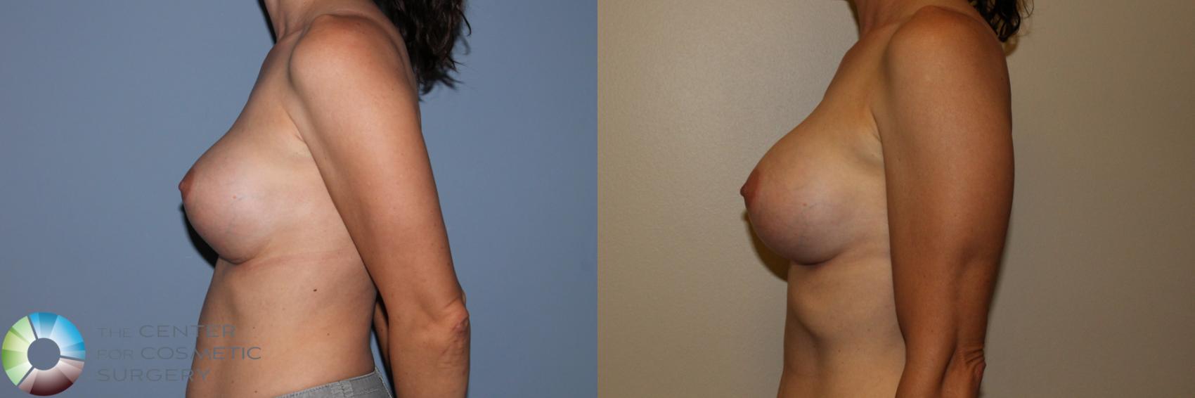 Before & After Breast Implant Revision Case 11501 Left Side View in Golden, CO