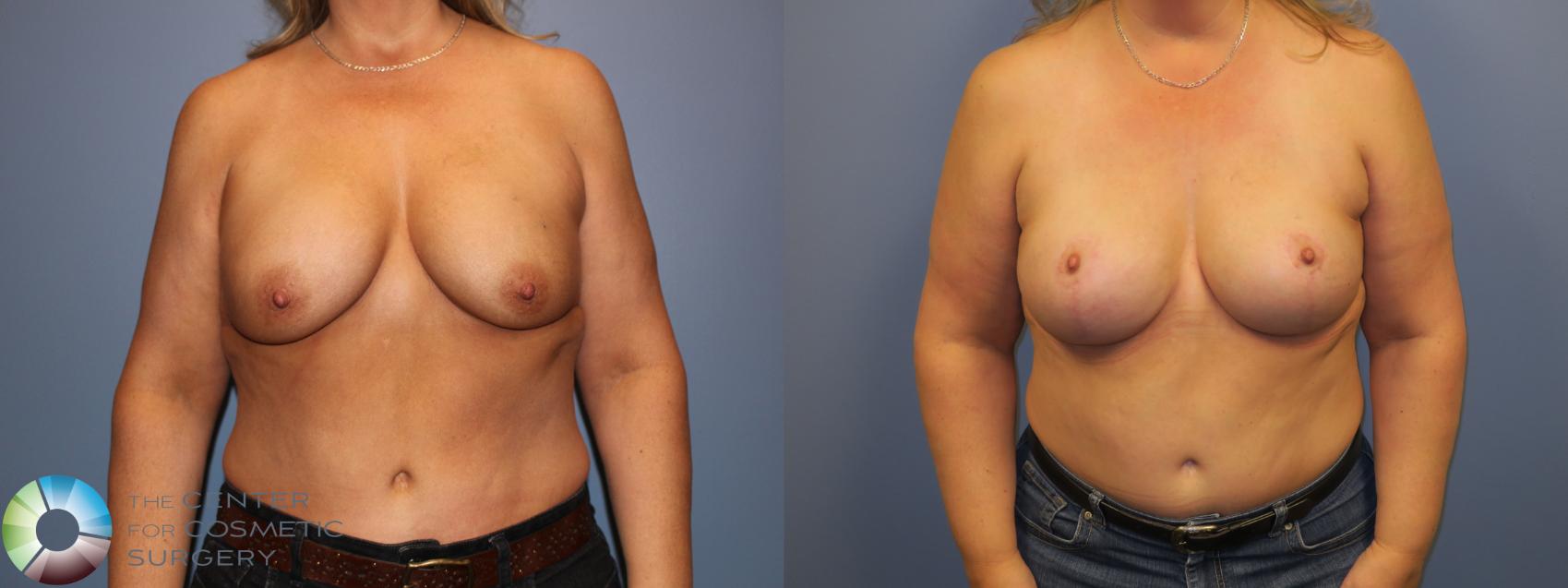 Before & After Breast Implant Revision Case 11505 Front View in Golden, CO
