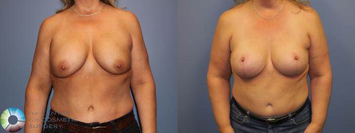 Before & After Breast Implant Revision Case 11505 Front in Denver and Colorado Springs, CO