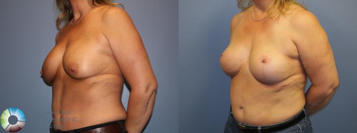 Before & After Breast Implant Revision Case 11505 Left Oblique in Denver and Colorado Springs, CO