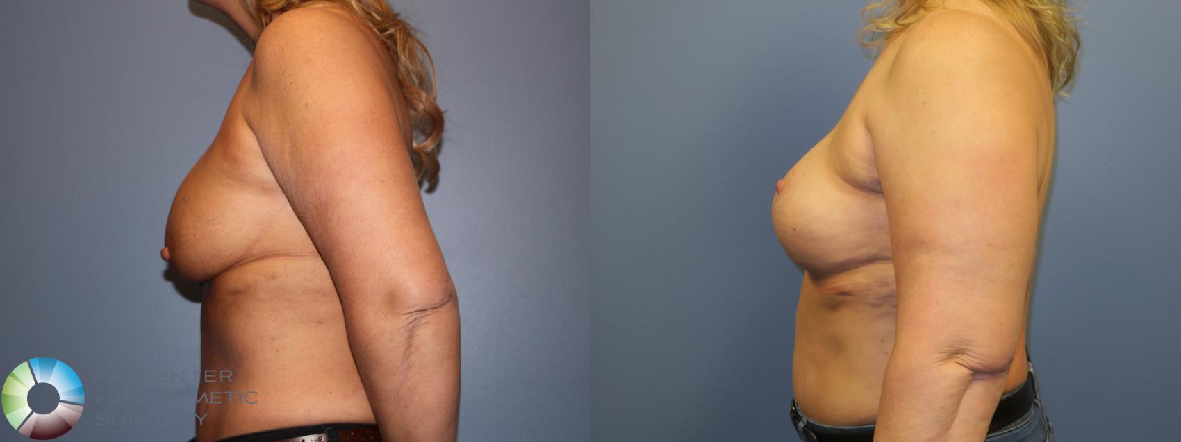 Before & After Breast Implant Revision Case 11505 Left Side View in Golden, CO