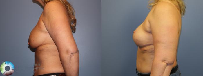 Before & After Breast Implant Revision Case 11505 Left Side in Denver and Colorado Springs, CO