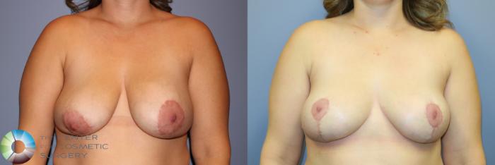Before & After Breast Implant Revision Case 11510 Front in Denver, CO