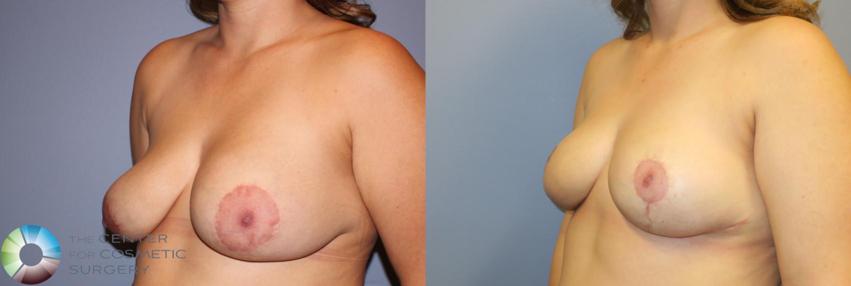 Before & After Breast Implant Revision Case 11510 Left Oblique in Denver and Colorado Springs, CO
