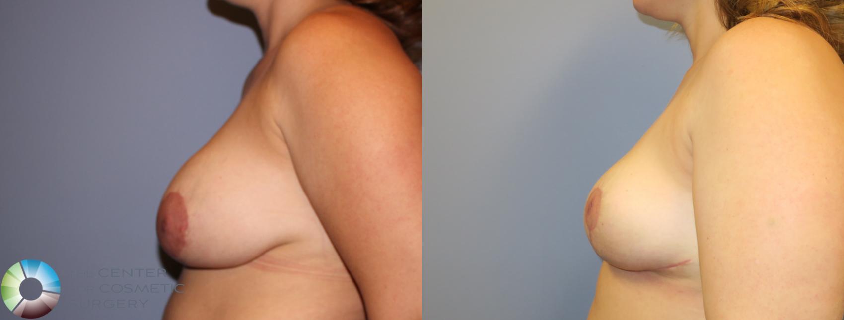 Before & After Breast Implant Revision Case 11510 Left Side in Denver and Colorado Springs, CO