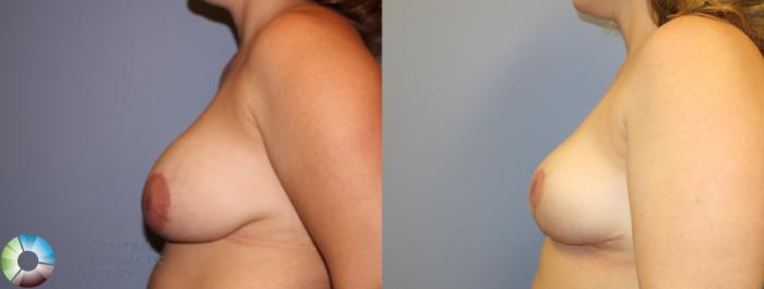 Before & After Breast Implant Removal (Explant) Case 11510 Left Side in Denver and Colorado Springs, CO