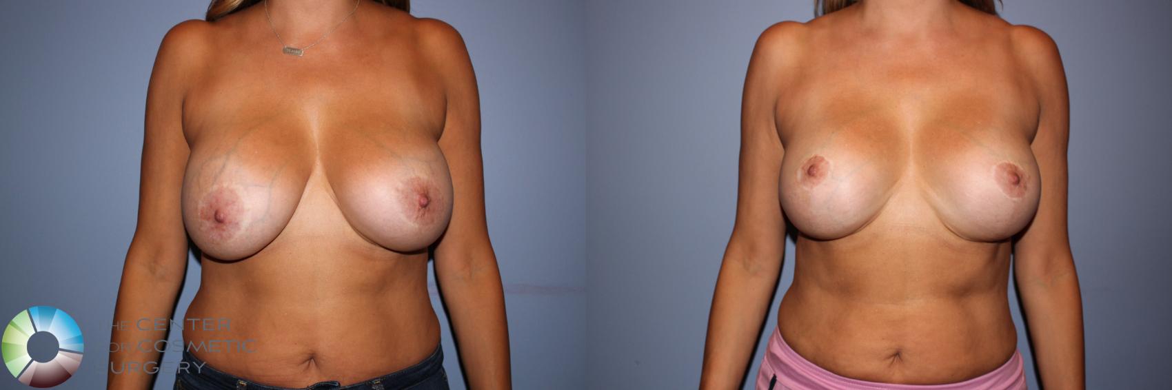 Before & After Breast Implant Revision Case 11527 Front View in Denver & Golden, CO