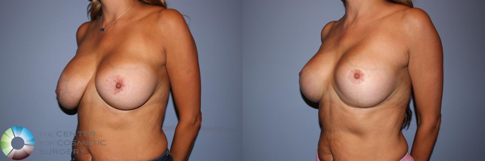 Before & After Breast Implant Revision Case 11527 Left Oblique in Denver and Colorado Springs, CO