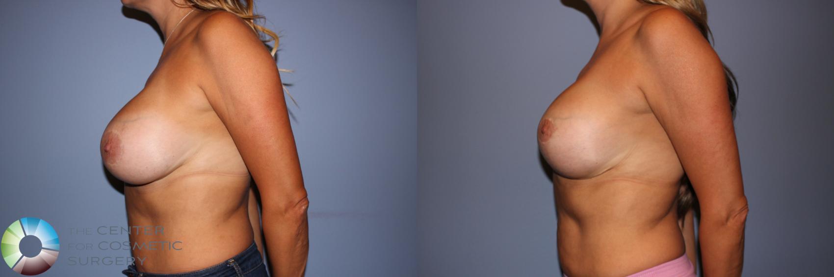 Before & After Breast Implant Revision Case 11527 Left Side View in Denver & Golden, CO