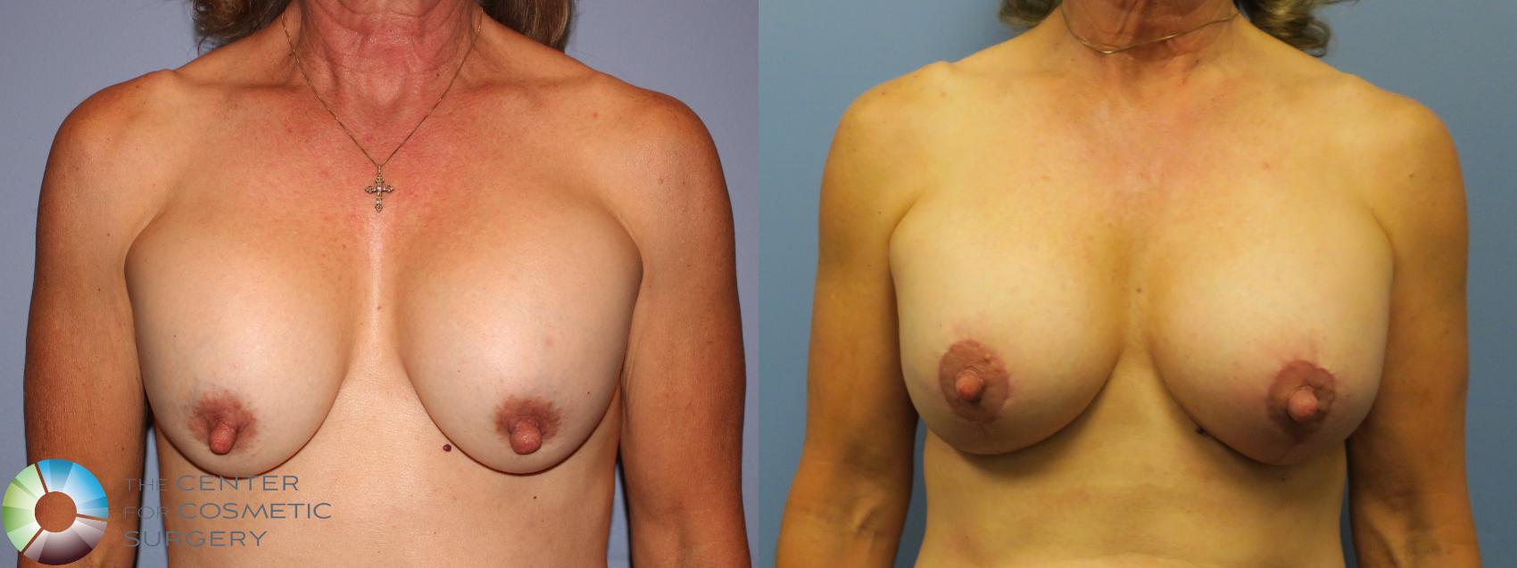 Before & After Breast Implant Revision Case 11610 Front in Denver and Colorado Springs, CO