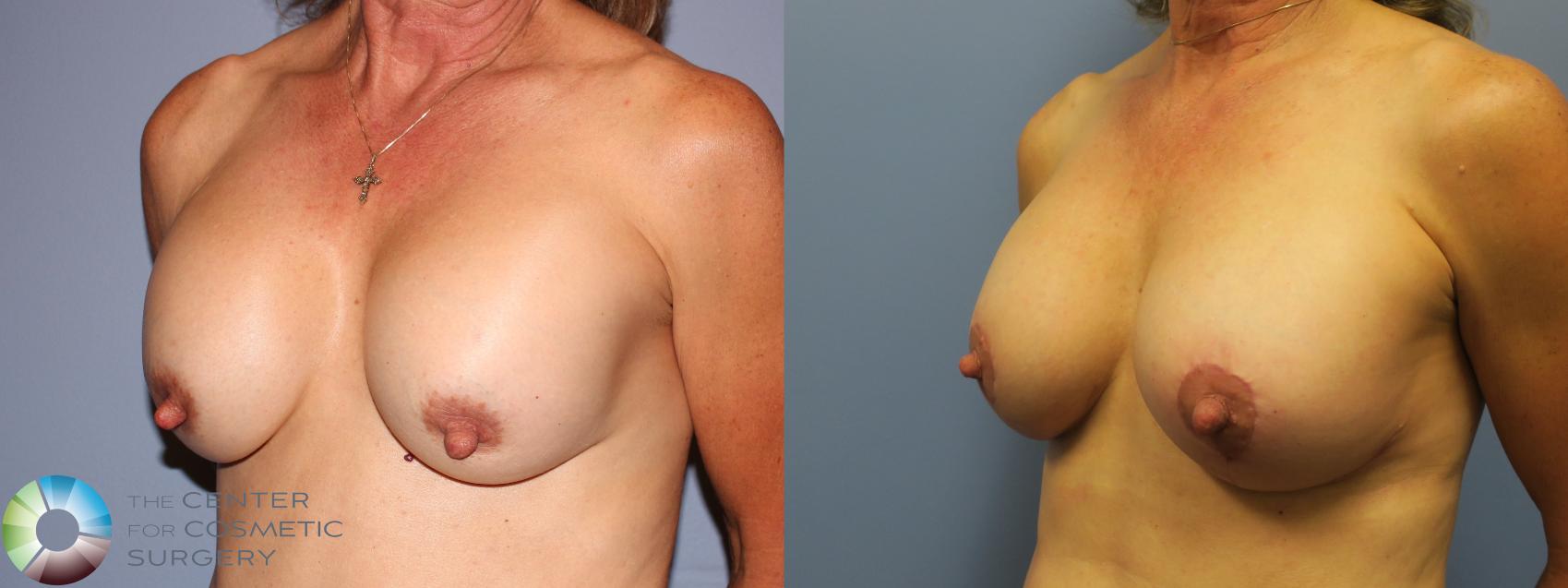 Before & After Breast Implant Revision Case 11610 Left Oblique in Denver and Colorado Springs, CO