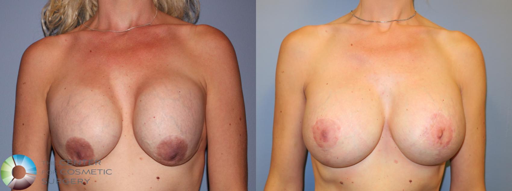 Before & After Breast Implant Revision Case 11622 Front View in Golden, CO