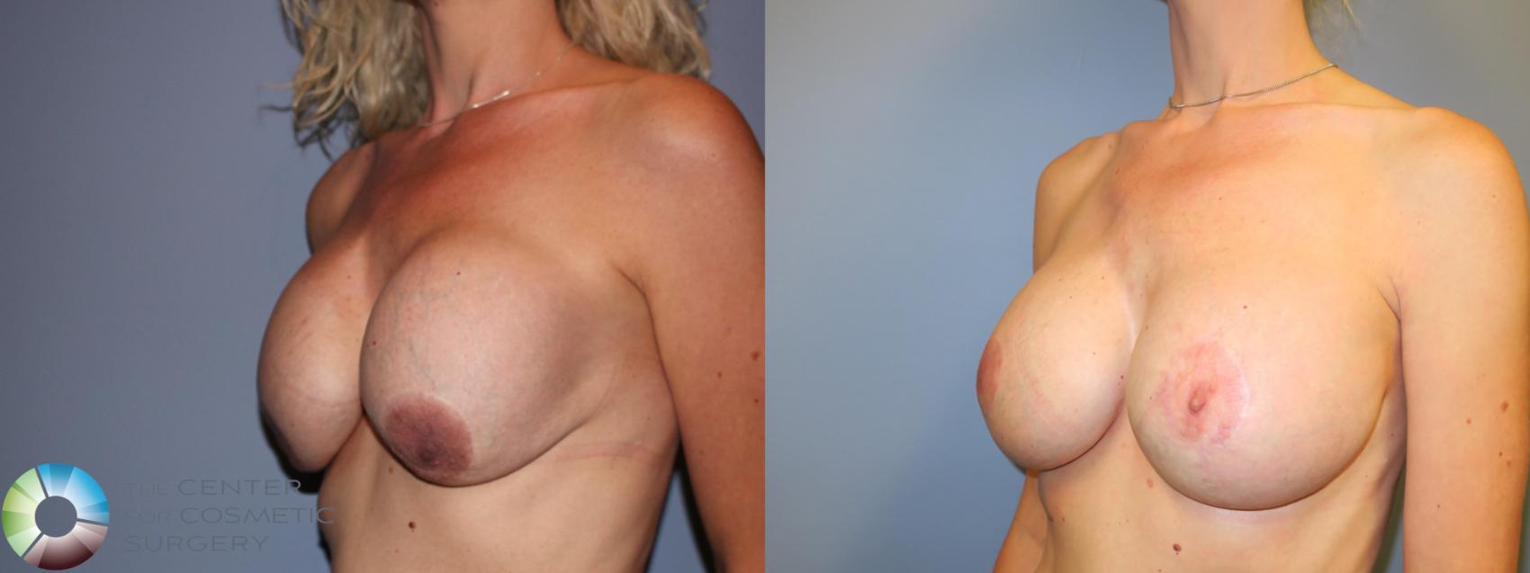 Best Denver Breast Revision Surgery