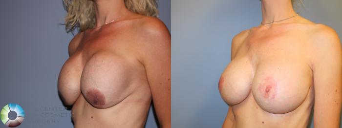 Before & After Breast Implant Revision Case 11622 Left Oblique View in Golden, CO