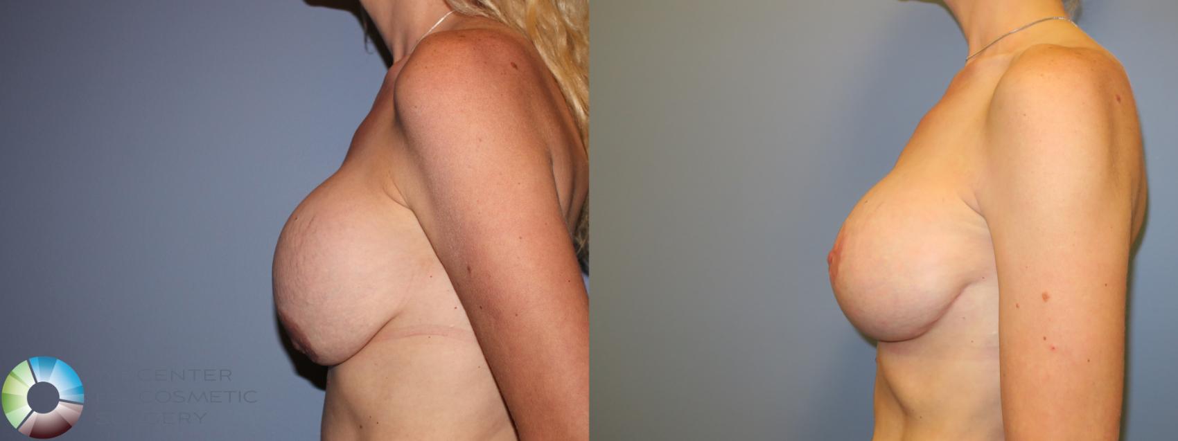 Best Denver Breast Revision Surgery