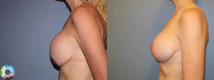 Before & After Breast Implant Revision Case 11622 Left Side View in Golden, CO