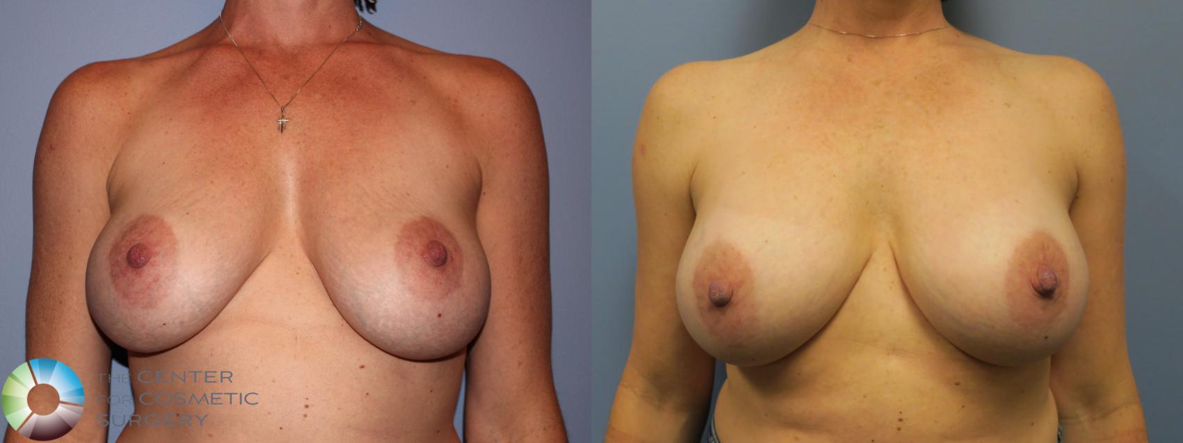 Before & After Breast Implant Revision Case 11623 Front in Denver and Colorado Springs, CO