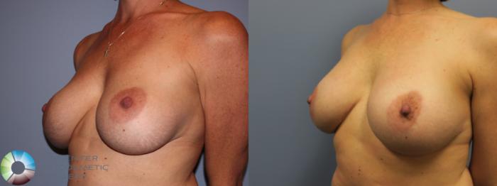 Before & After Breast Implant Revision Case 11623 Left Oblique in Denver and Colorado Springs, CO