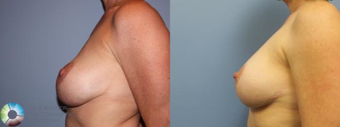 Before & After Breast Implant Revision Case 11623 Left Side in Denver and Colorado Springs, CO
