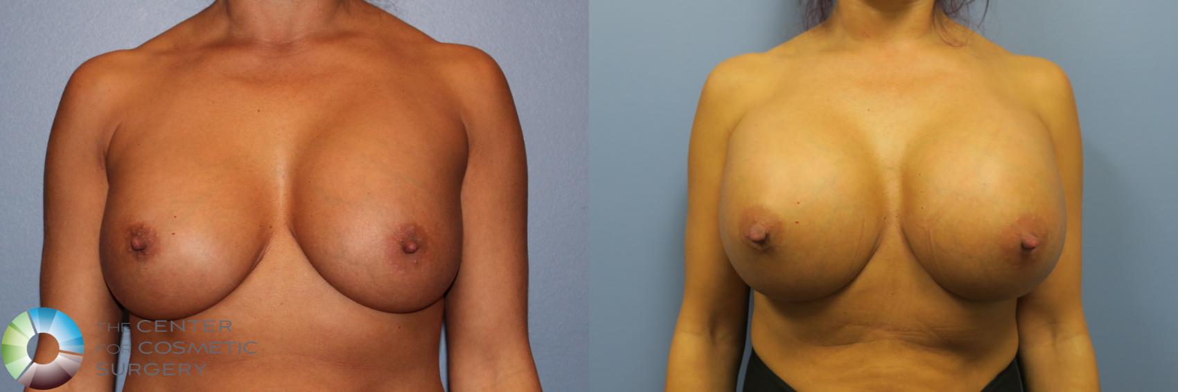 Before & After Breast Implant Revision Case 11648 Front in Denver and Colorado Springs, CO