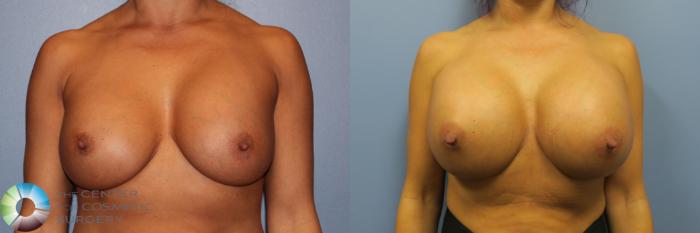 Before & After Breast Implant Revision Case 11648 Front View in Golden, CO