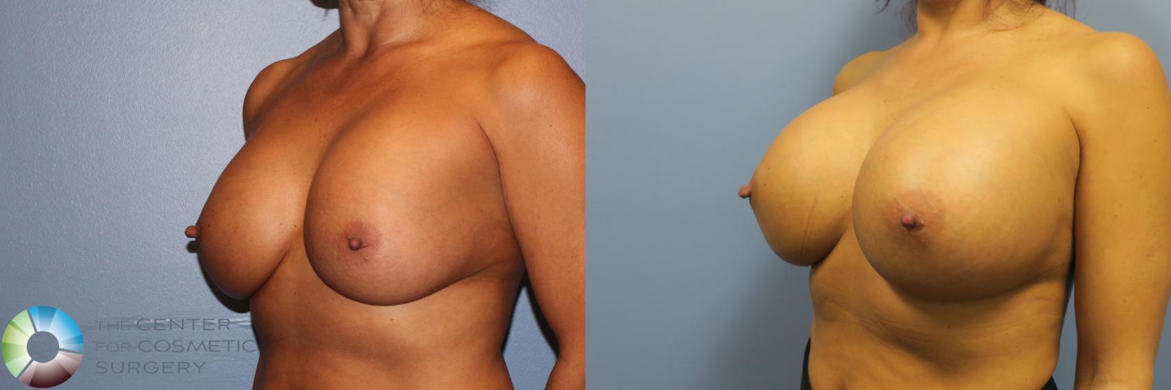 Best Denver Breast Revision Surgery