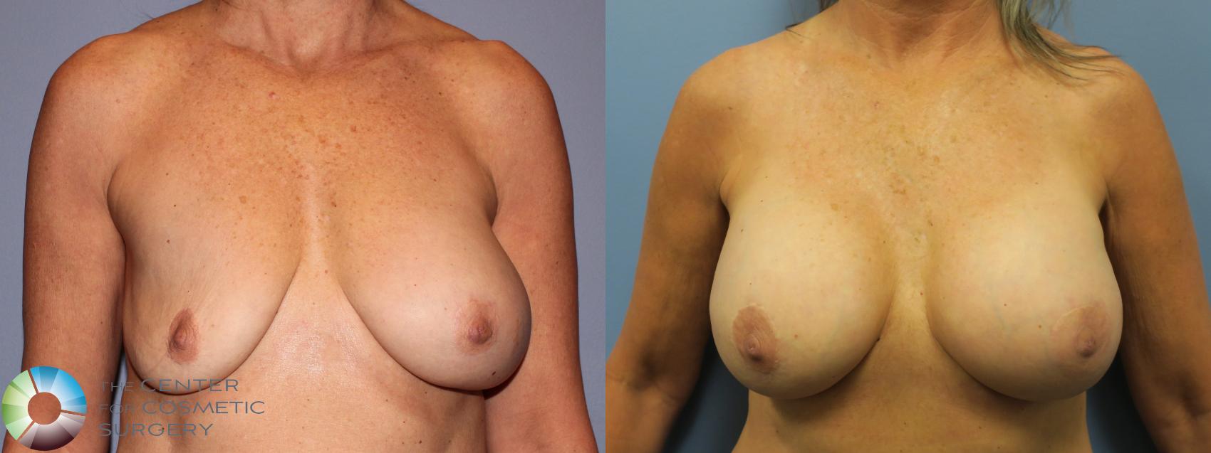 Before & After Breast Implant Revision Case 11649 Front in Denver and Colorado Springs, CO