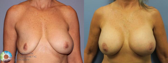 Before & After Breast Implant Revision Case 11649 Front View in Golden, CO