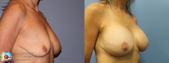 Before & After Breast Implant Revision Case 11649 Right Oblique View in Golden, CO