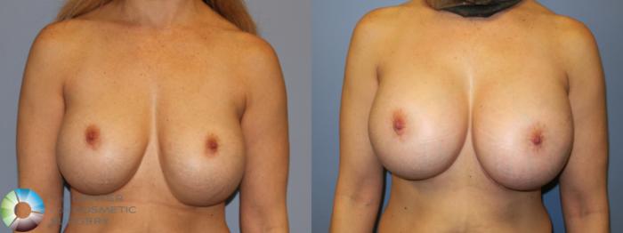 Before & After Breast Implant Revision Case 11660 Front in Denver and Colorado Springs, CO