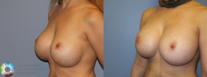 Before & After Breast Implant Revision Case 11660 Left Oblique in Denver and Colorado Springs, CO
