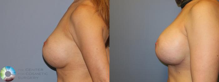 Before & After Breast Implant Revision Case 11660 Left Side in Denver and Colorado Springs, CO