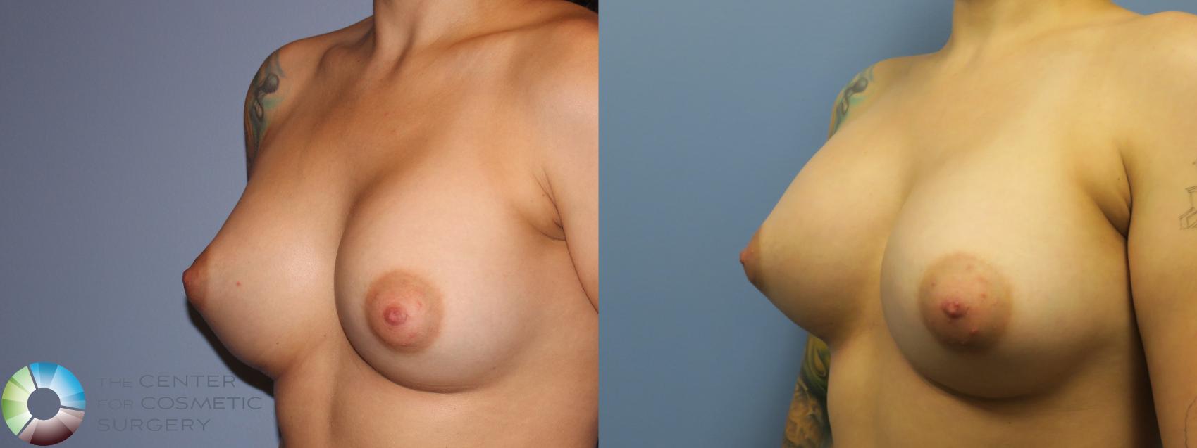 Before & After Breast Implant Revision Case 11662 Left Oblique in Denver and Colorado Springs, CO