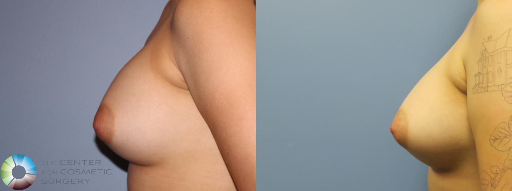 Before & After Breast Implant Revision Case 11662 Left Side in Denver and Colorado Springs, CO