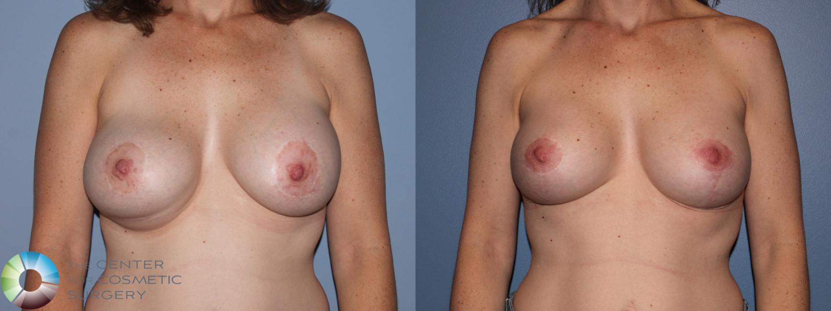 Before & After Breast Implant Revision Case 11702 Front View in Golden, CO