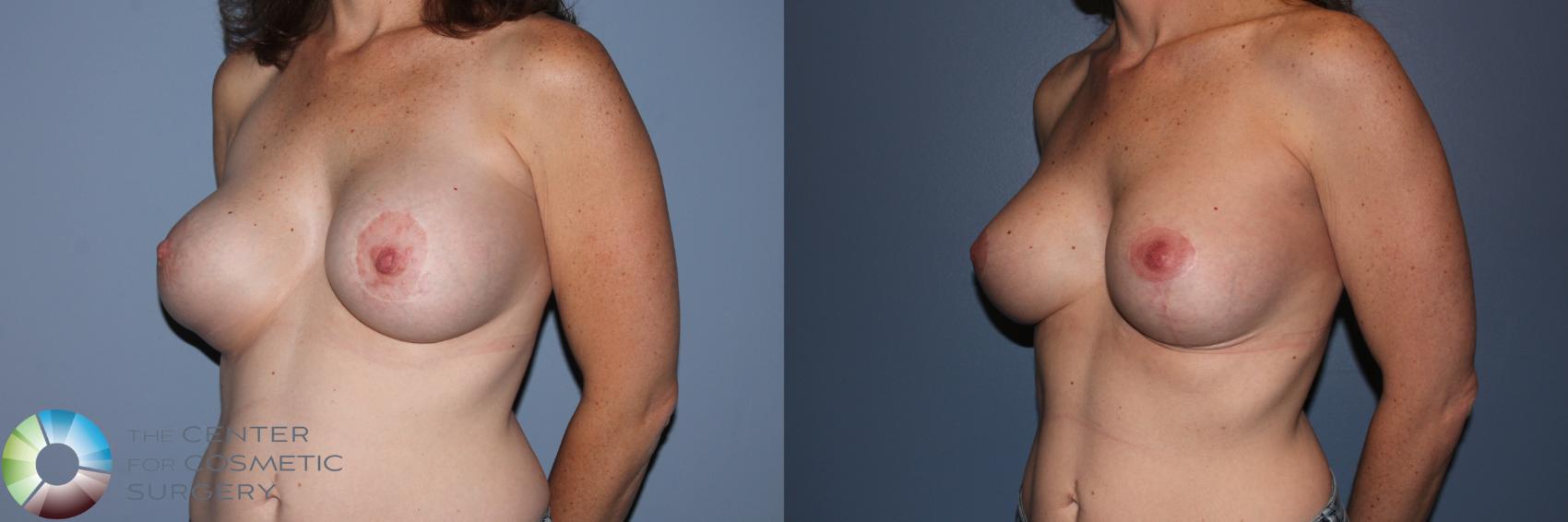 Before & After Breast Implant Revision Case 11702 Left Oblique in Denver and Colorado Springs, CO