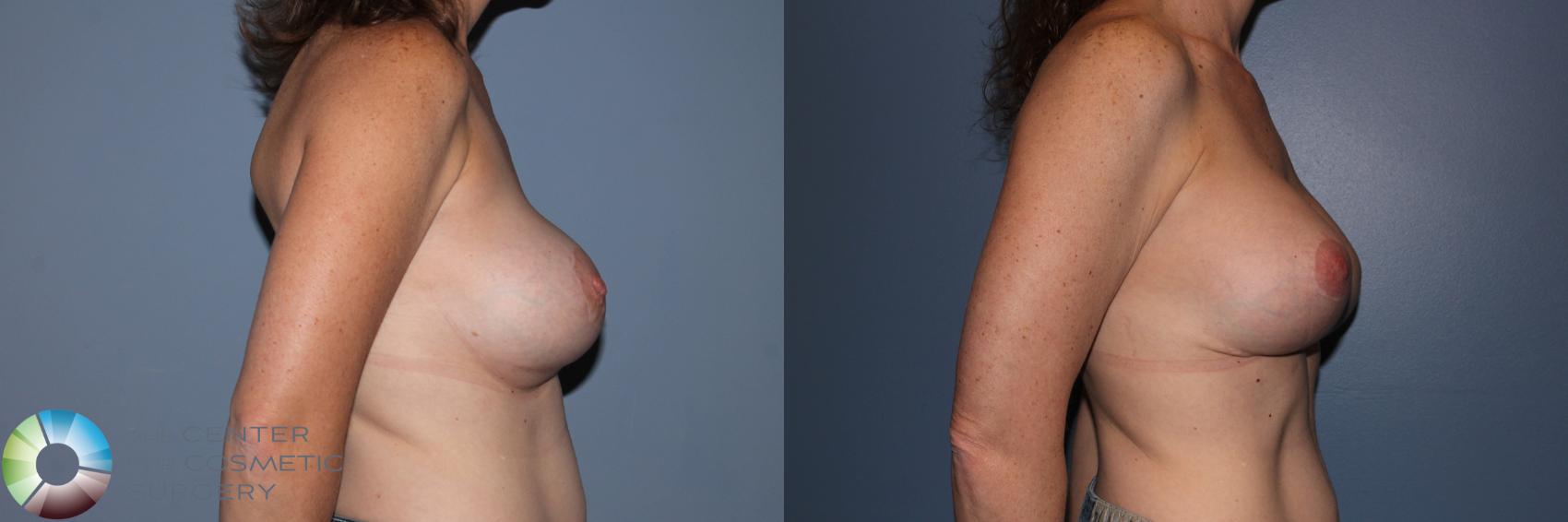 Before & After Breast Implant Revision Case 11702 Right Side in Denver and Colorado Springs, CO