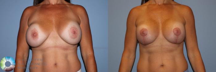 Before & After Breast Implant Revision Case 11705 Front in Denver and Colorado Springs, CO