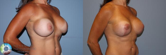 Before & After Breast Implant Revision Case 11705 Right Oblique in Denver and Colorado Springs, CO