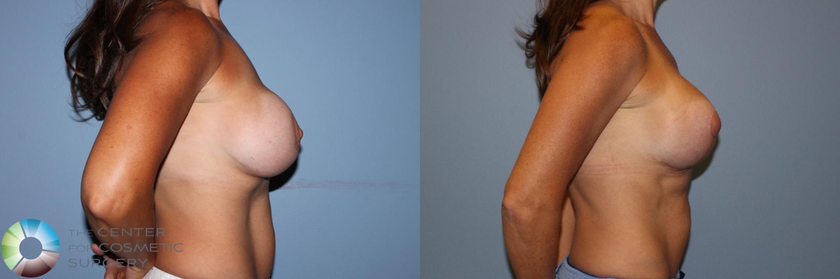 Before & After Breast Implant Revision Case 11705 Right Side View in Golden, CO