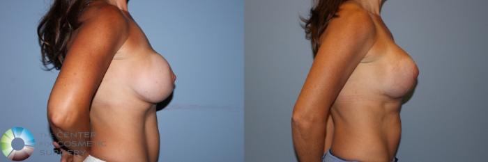 Before & After Breast Implant Revision Case 11705 Right Side in Denver and Colorado Springs, CO