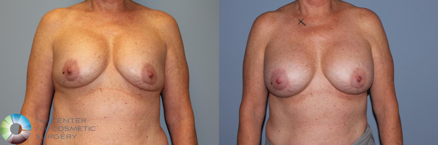 Before & After Breast Implant Revision Case 11720 Front View in Golden, CO