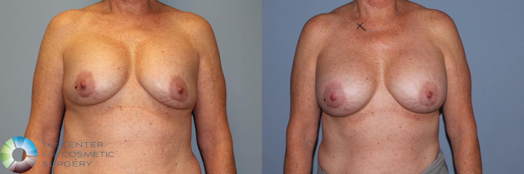 Before & After Breast Implant Revision Case 11720 Front in Denver and Colorado Springs, CO