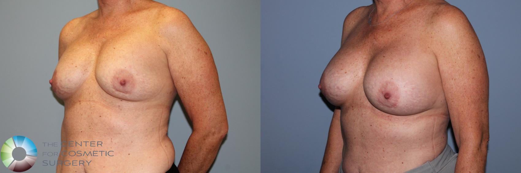 Before & After Breast Implant Revision Case 11720 Left Oblique View in Golden, CO
