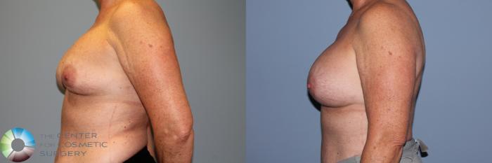 Before & After Breast Implant Revision Case 11720 Left Side View in Golden, CO
