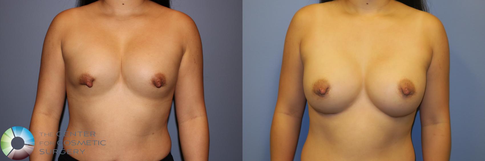 Before & After Breast Implant Revision Case 11722 Front in Denver, CO