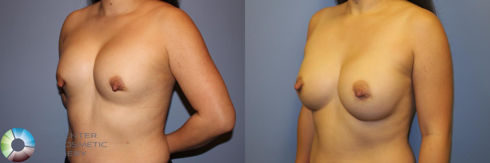 Before & After Breast Implant Revision Case 11722 Left Oblique in Denver and Colorado Springs, CO