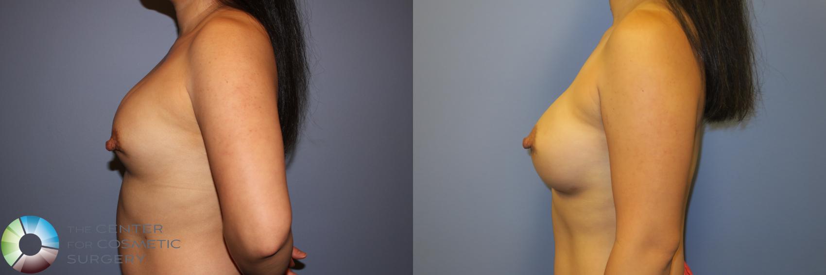 Before & After Breast Implant Revision Case 11722 Left Side in Denver and Colorado Springs, CO