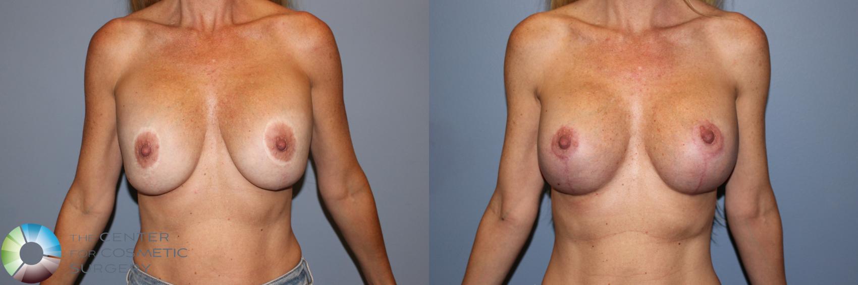 Before & After Breast Implant Revision Case 11723 Front View in Golden, CO