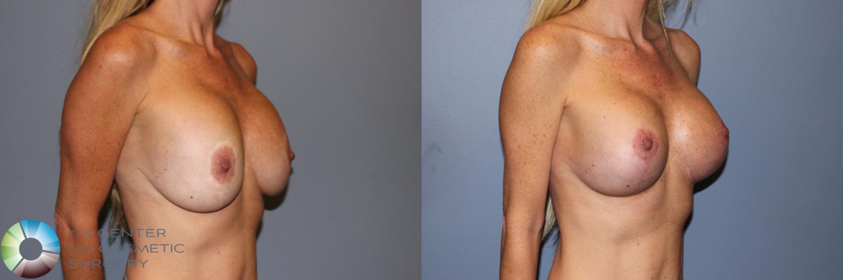 Before & After Breast Implant Revision Case 11723 Right Oblique View in Golden, CO
